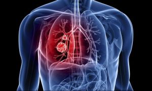 Cancerul pulmonar, cea mai agresivă formă de boală. 8 soluții pentru depistare și tratament