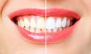 Care sunt top 5 cele mai dăunătoare alimente pentru sănătatea dinților? 