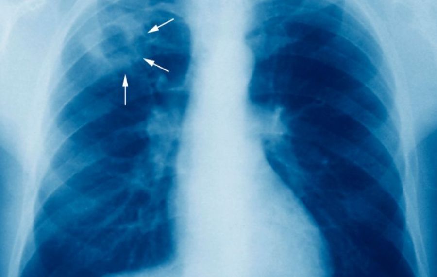 Studiu: Tuberculoza poate fi transmisă printr-o simplă respirație