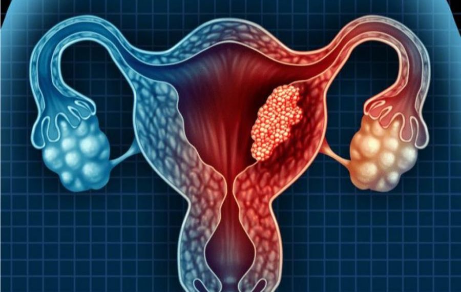 Cum poate fi prevenit cancerul de col uterin?